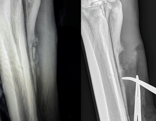 draining-wound-associated-with-splint-bone
