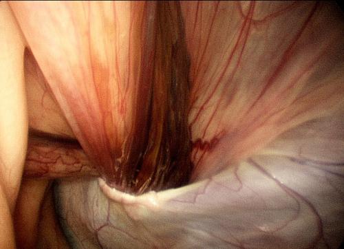 inguinal-canal-prior-to-hernioplasty