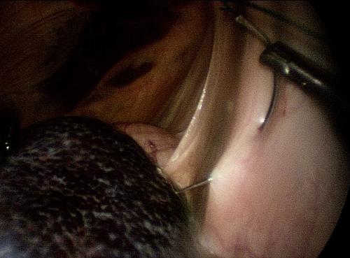 suturing-the-nephrosplenicspace